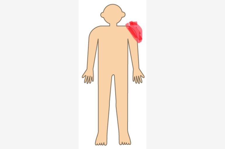 肩にも神経痛はあります 名古屋の接骨院では皆様の健康に役立つ情報をブログから発信しております